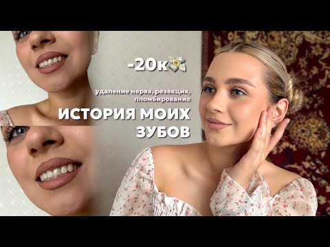 Видео: ИСТОРИЯ МОИХ ЗУБОВ: кариес, удаление нерва, резекция | отдала за лечение зуба 20к 🦷