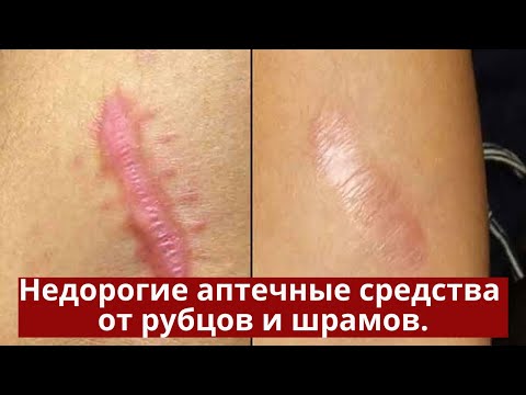 Видео: Недорогие аптечные средства от рубцов и шрамов. Метилурацил, камфора, лидаза.