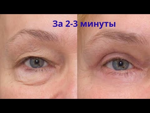 Видео: Как убрать отеки с глаз и подтянуть нависшее верхнее веко?
