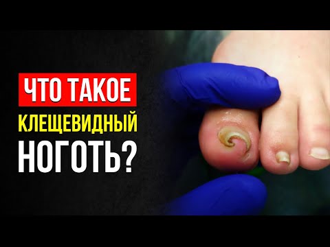 Видео: 4 СОВЕТА КАК ИЗБАВИТЬСЯ ОТ КЛЕЩЕВИДНОГО НОГТЯ? ЧТО ЭТО ТАКОЕ? СОВЕТЫ И МНЕНИЕ ПОДОЛОГА