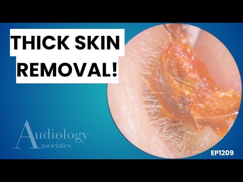 Видео: Глубокая чистка ушей | Нервный пациент с скоплением ушной серы - EP1209
