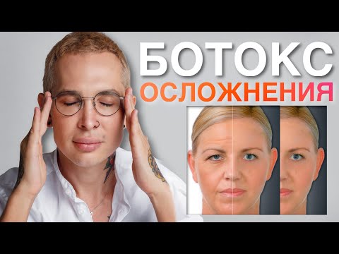 Видео: БОТОКС ОСЛОЖНЕНИЯ #ботокс