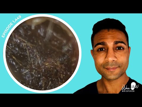 Видео: 1449 — сложное удаление ушной серы у 10-летнего ребенка, который успешно прошел проверку слуха, н...