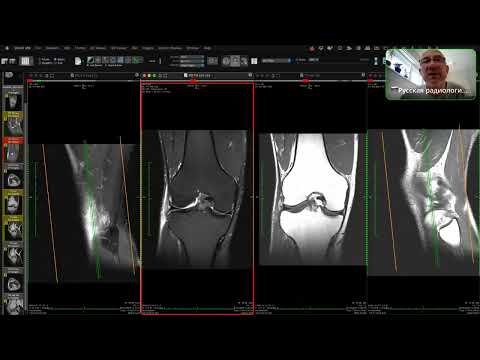 Видео: МРТ - колено - живой разбор - 31.05.2024