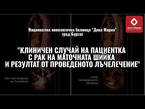 Видео: Лъчетерапия при пациентки с рак на маточната шийка - резултати от проведено лъчелечение