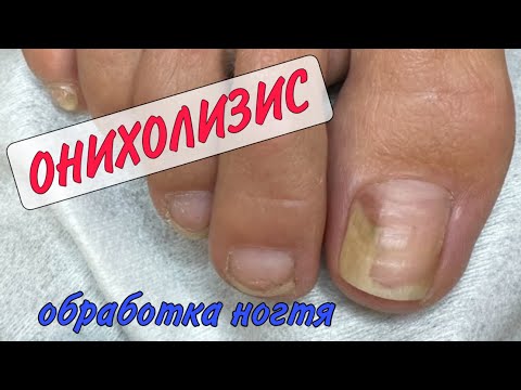 Видео: 👉🏻 ОНИХОЛИЗИС / карман под ногтем / зачистка ногтя