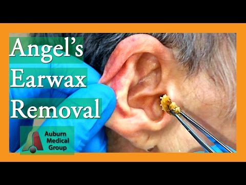 Видео: Ушная Удаление Ангела