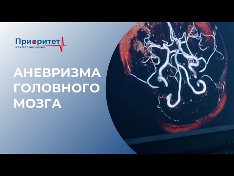 Видео: Аневризма головного мозга I Главный врач Топольскова