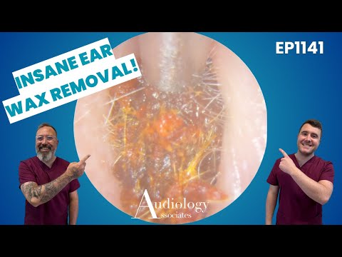 Видео: Эпическое удаление ушной серы: гигантские ушные пробки и приятные кожно-кожные полоски! - EP1141