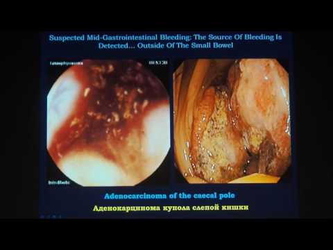 Видео: 03 Федоров ЕД   Диагностика и лечение внутрипросветных желудочно кишечных кровотечений неустановленн