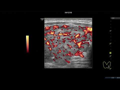 Видео: Клинический случай 8. (УЗИ Щитовидной Железы ) доктор А.В. Ушаков