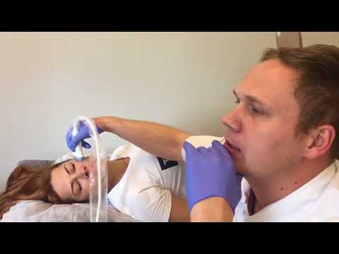 Видео: УЗИ филлеров ( Радиесс) после контрной пластики лица