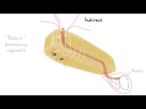 Видео: Как возникают паховые грыжи?