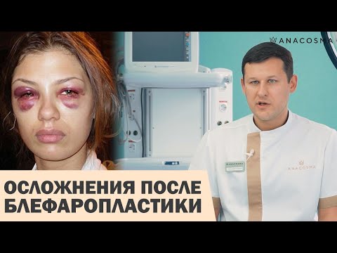 Видео: ОСЛОЖНЕНИЯ ПОСЛЕ БЛЕФАРОПЛАСТИКИ 😱🤯 КАК ИЗБЕЖАТЬ ❓