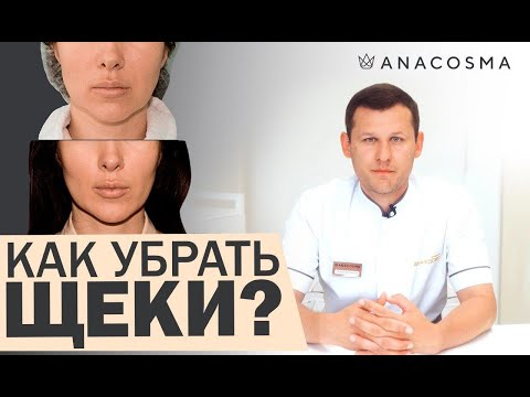 Видео: 👉Как убрать ЩЕКИ и сделать СКУЛЫ👉 Удаление комков Биша ДО ПОСЛЕ 👍Липосакция щек / Миронов Андрей