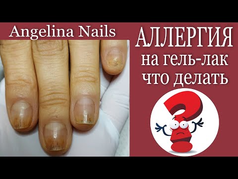 Видео: Аллергия на гель-лак / наращивание выкладного френча / сложная кутикула для аппаратного маникюра /
