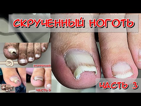 Видео: Скрученные ногти - "Капитан Аэро" (Часть 3) / Коррекционная система 3 ТО скоба.