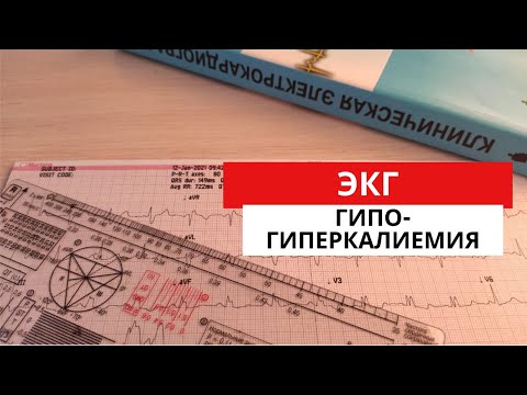 Видео: Гипокалиемия. Гиперкалиемия. ЭКГ диагностика электролитных нарушений.  Физиология.