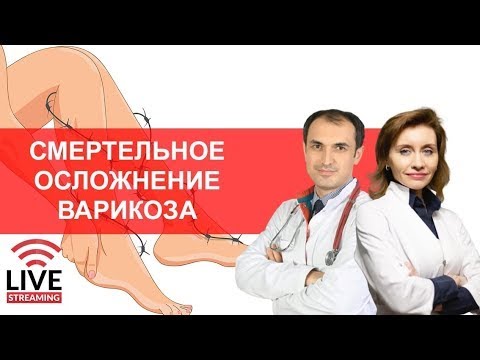 Видео: Смертельное осложнение варикоза. Флеболог. Москва.