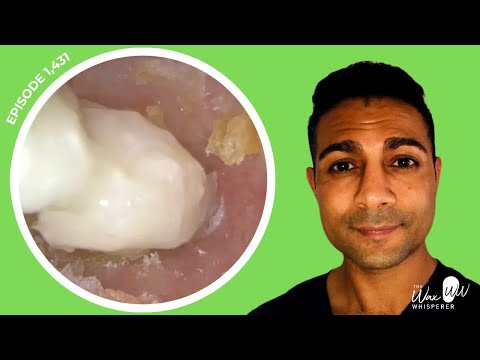 Видео: 1431 - Комплексное удаление корки из омертвевшей кожи уха | 2 большие перфорации | Активные выдел...