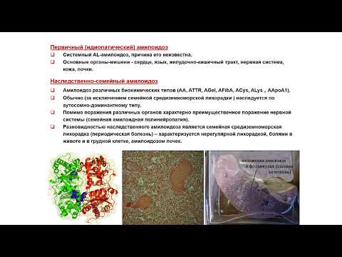 Видео: УЗИ. Доктор Иогансен. Выпуск 62. Спленомегалия и диффузные изменения селезенки. Часть 2.