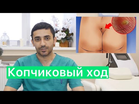 Видео: Подробно о кисте копчика  - причины, симптомы и как удаляют  копчиковую кисту