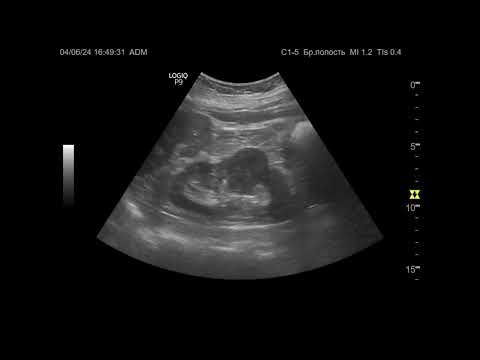 Видео: Ультразвуковая диагностика. Доктор Иогансен. Видеопримеры. Выпуск 80. Рак почки.