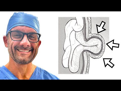 Видео: Пупочные грыжи – это просто