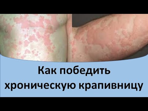 Видео: Как победить хроническую крапивницу.