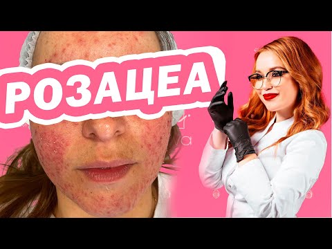 Видео: РОЗАЦЕА что это такое и как лечить? (КУПЕРОЗ, или РОЗОВЫЕ УГРИ)