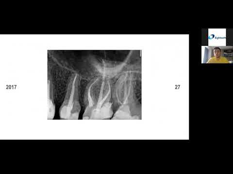 Видео: Вебинар на русском языке -  Дмитрий Николаев-  Тема: Трехмерная обтурация системы корневых каналов