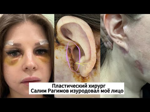 Видео: ПЛАСТИЧЕСКИЙ ХИРУРГ ИЗУРОДОВАЛ лицо, 5 месяцев гнила.Хирург Салим Рагимов#баку#блефаропластика#врек
