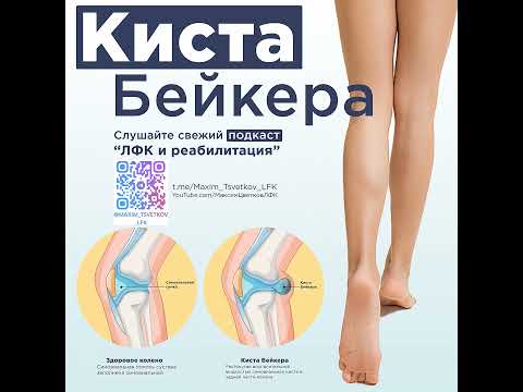 Видео: Киста Бейкера
