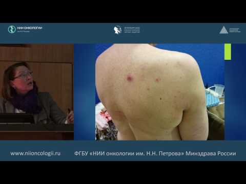 Видео: Клинический опыт применения Винорелбина в капсулах в Республике Карелия