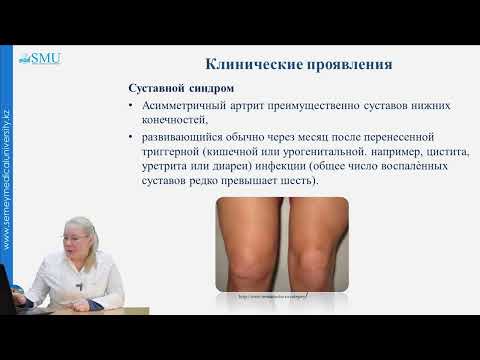 Видео: Реактивный артрит