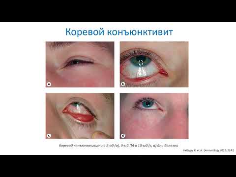 Видео: Корь  Ключевые моменты