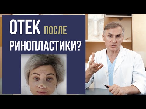 Видео: ОТЕК ПОСЛЕ РИНОПЛАСТИКИ 🤭😱 ПРОБЛЕМА❓