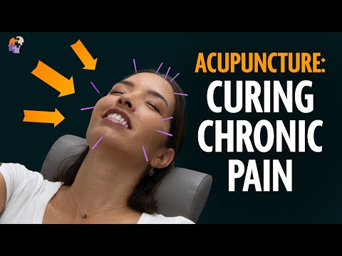 Видео: Иглоукалывание для облегчения боли: действительно ли это работает?