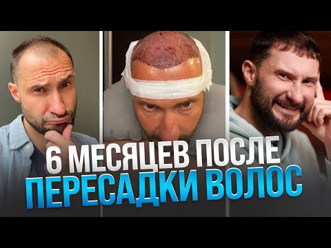 Видео: 6 месяцев после пересадки волос | Честный отзыв