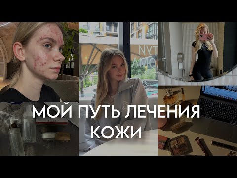 Видео: мой путь лечения кожи - системные ретиноиды, побочки, мой уход для всего тела