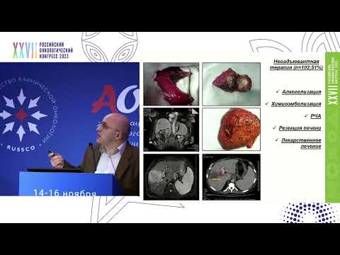 Видео: Расширение показаний для трансплантации печени при ГЦР и ХЦР