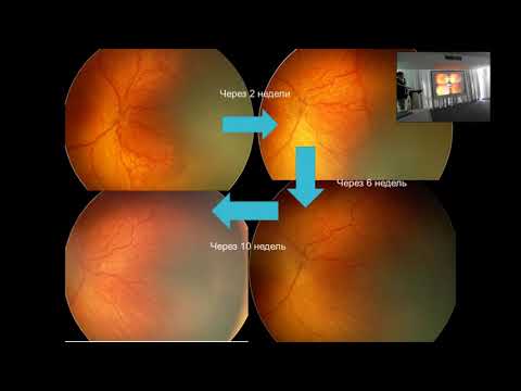 Видео: «Эффективность афлиберцепта при ретинопатии недоношенных»
