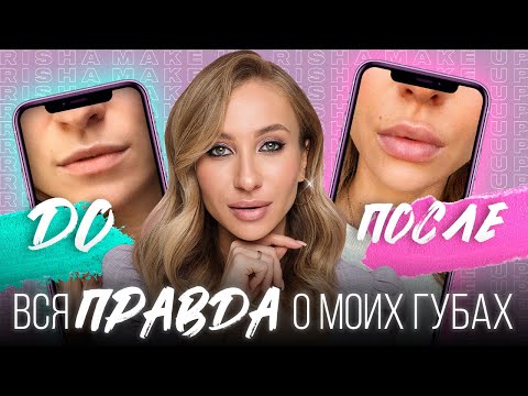Видео: Инъекционное увеличение губ филлером: Мой опыт
