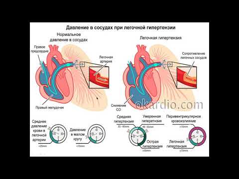 Видео: Легочная артериальная гипертензия, Легочное сердце