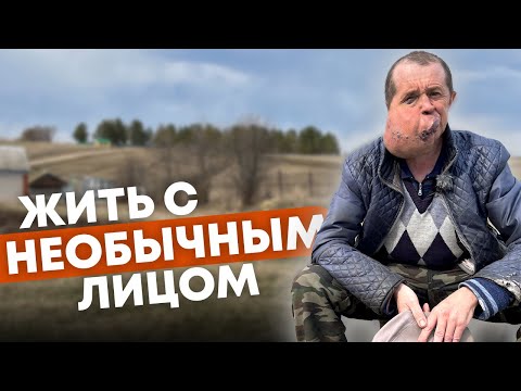Видео: Жить с необычным лицом
