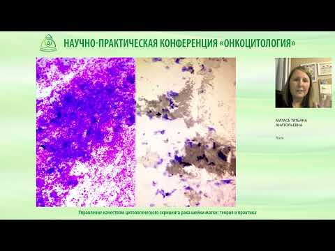 Видео: Управление качеством цитологического скрининга рака шейки матки   теория и практика
