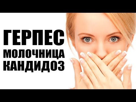 Видео: Герпес, Молочница, Кандидоз - Иммунитет и Вирусы