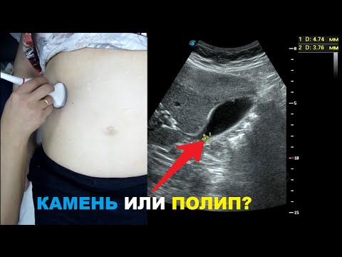 Видео: Как отличить ПОЛИП желчного пузыря от КАМНЯ желчного пузыря?