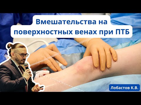 Видео: Доклад "Вмешательства на поверхностных венах при ПТБ" (17.06.23)