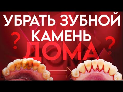 Видео: Как счистить зубной налёт и камень дома